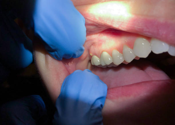 Best Emergency Wisdom Teeth Removal in Pughtown, PA